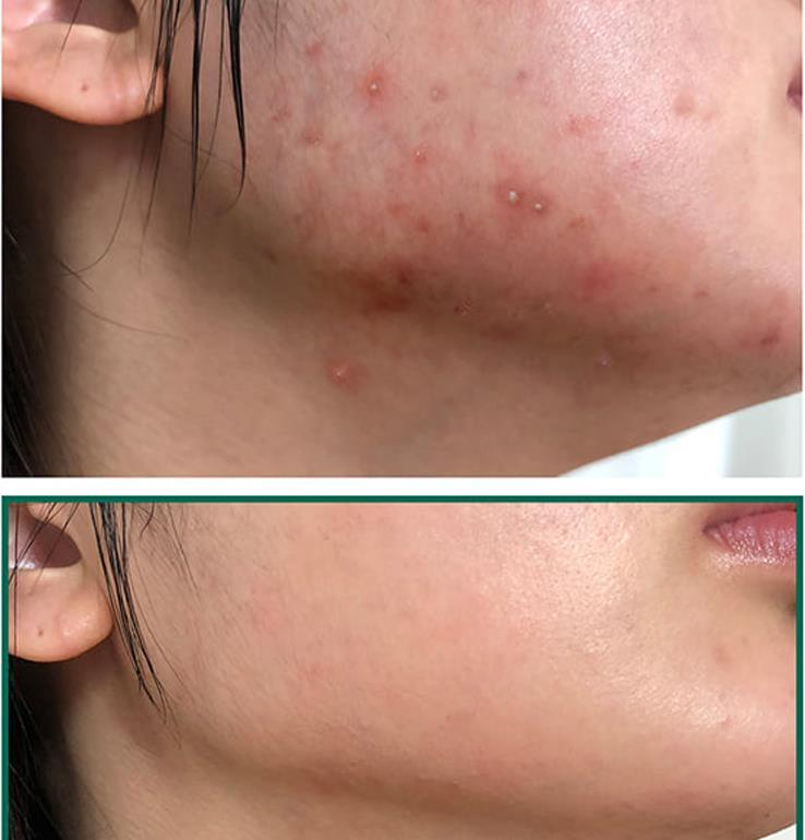 Before and after comparison of acne-prone skin on a person's face.