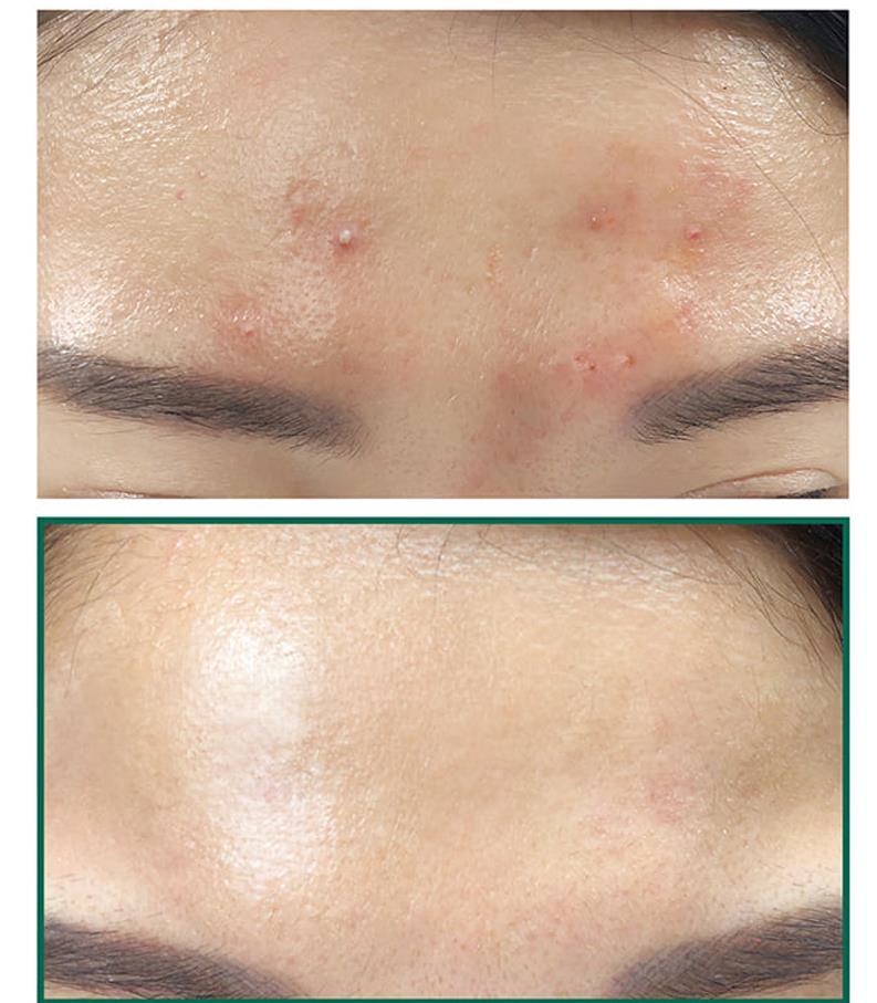 Before and after comparison of acne on a person's face.