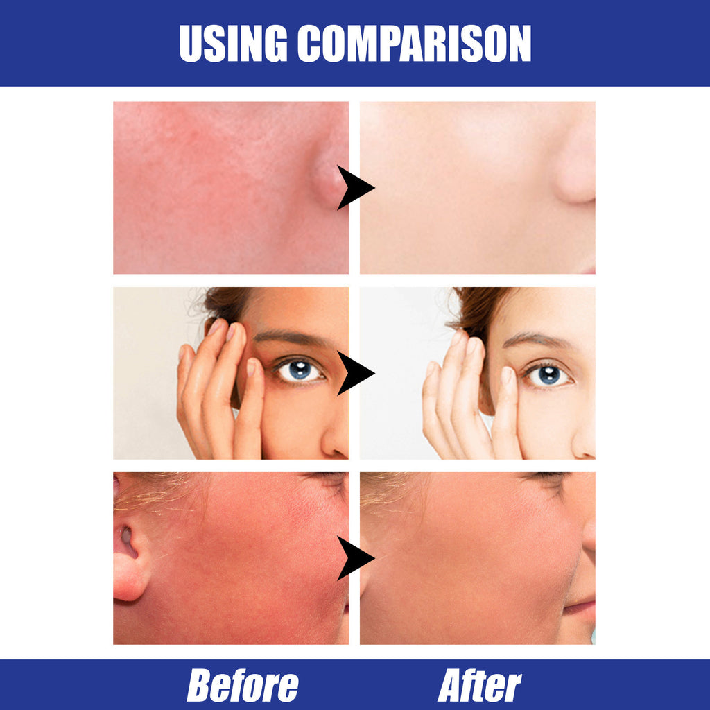 Before and after comparison of skin treatment on a person's face.