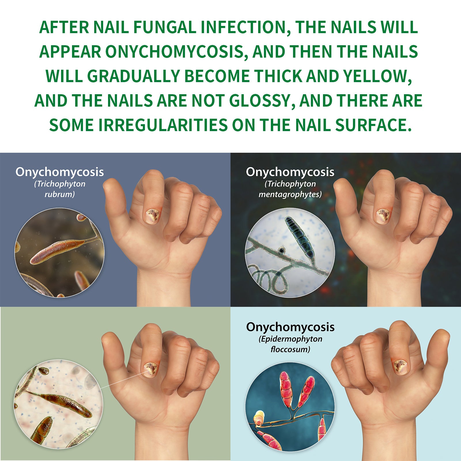 Information on onychomycosis with images of hands and microscopic views of fungi.